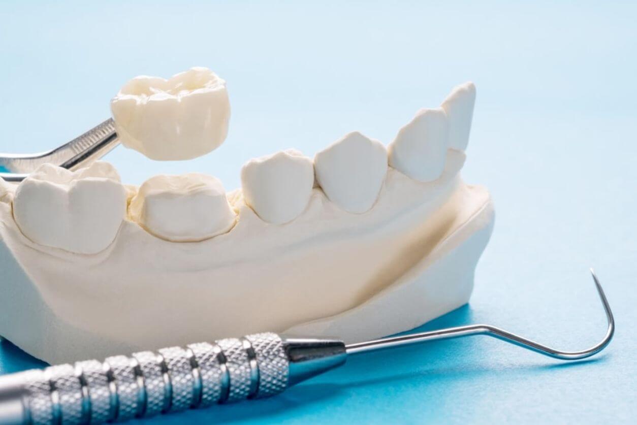 Dealing with a Loose Implant Crown Your Complete Guide